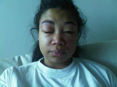 Mujer con el rostro hinchado debido al lupus 